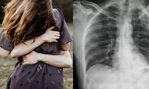 സ്‌നേഹപ്രകടനം കടുത്തു : സഹപ്രവര്‍ത്തകന്റെ ആലിംഗനത്തില്‍ വാരിയെല്ലൊടിഞ്ഞ് യുവതി