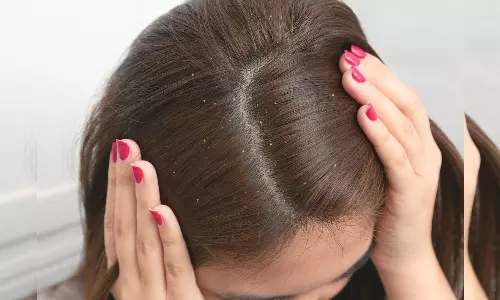 താരനകറ്റാൻ നെട്ടോട്ടമോടേണ്ട.. പ്രതിവിധിയുണ്ട്