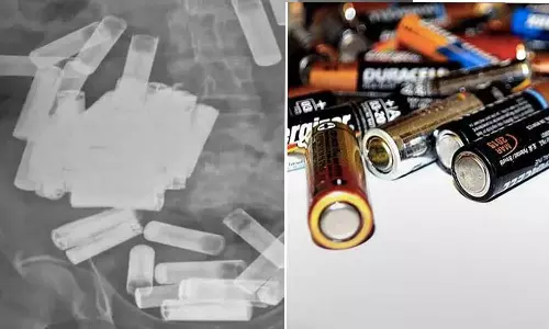 സ്ത്രീയുടെ വയറ്റിൽനിന്നും ശസ്ത്രക്രിയയിലൂടെ  നീക്കിയത് 55 ബാറ്ററികൾ..! ലോകത്താദ്യമെന്ന്  ഡോക്ടർമാർ