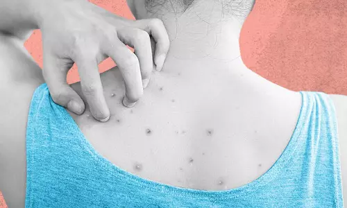 പുറത്തെ കുരുക്കൾ ശല്യമാകുന്നുണ്ടോ? പ്രതിവിധിയുണ്ട്