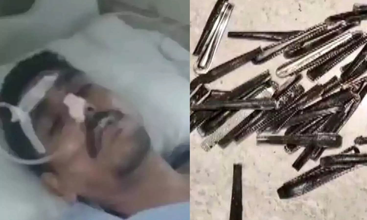 കടുത്ത വയറുവേദന; ശസ്ത്രക്രിയയില്‍ പുറത്തെടുത്തത് 63 സ്പൂണുകൾ!