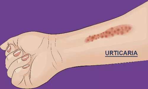 ശരീരം ചൊറിഞ്ഞു തടിക്കുന്നുണ്ടോ? അര്‍ട്ടിക്കേരിയ ആകാം!