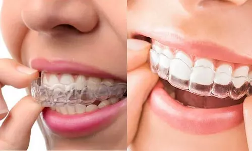 കമ്പിയിടാൻ പേടിയാണോ...നിരതെറ്റിയ പല്ലുകളെ ശരിയാക്കാനിതാ ഇൻവിസിബിൾ അലൈനേർ