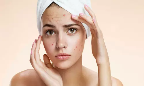 പാടുപെടേണ്ട; മുഖക്കുരു വന്നുപോയതിന് ശേഷമുള്ള പാടുകൾ കുറയ്‌ക്കാൻ വഴിയുണ്ട്