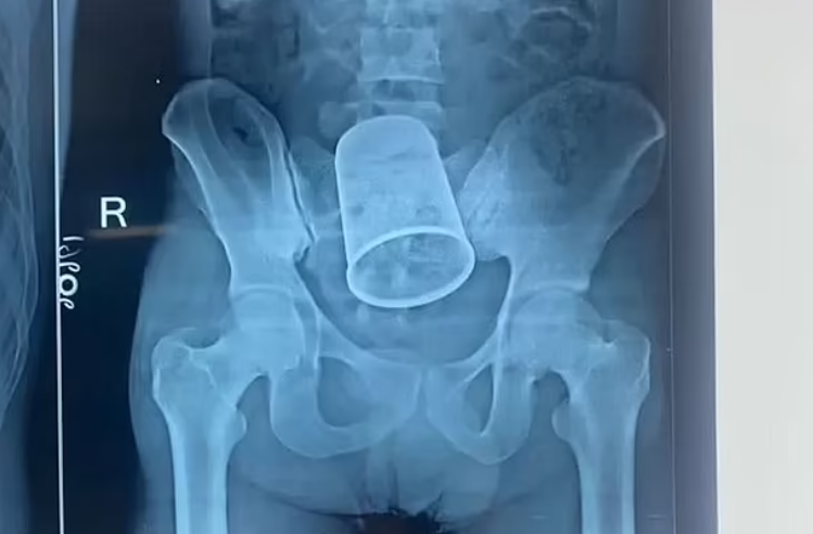 യുവാവിന്‍റെ വയറ്റില്‍ കുടുങ്ങിയ സ്റ്റീല്‍ ഗ്ലാസ് ശസ്ത്രക്രിയയിലൂടെ പുറത്തെടുത്തു