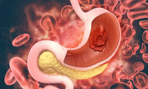 നിങ്ങളുടെ വയറ്റിൽ കാൻസർ വളരുന്നുണ്ടോ! എങ്ങനെ തിരിച്ചറിയാം? നിങ്ങളുടെ വയറ്റിൽ കാൻസർ വളരുന്നുണ്ടോ! എങ്ങനെ തിരിച്ചറിയാം?