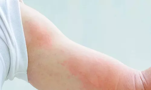 ശരീരം ചൊറിഞ്ഞു തടിക്കുന്നുണ്ടോ ? ഇതാണ് കാരണം