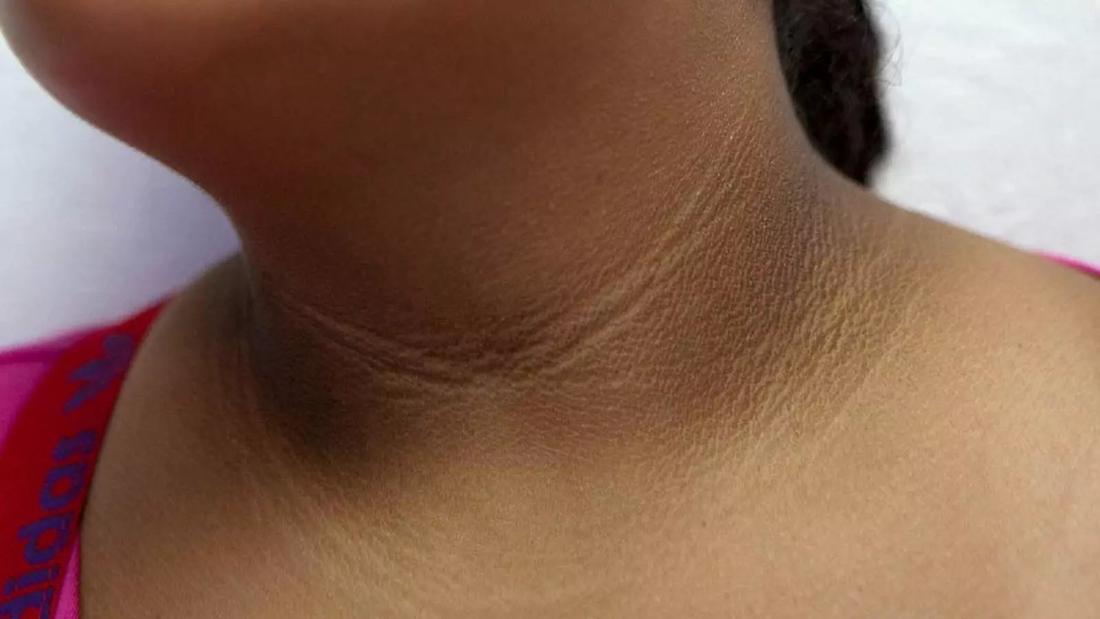 കഴുത്തിലെയും കക്ഷത്തിലെയും കറുത്തപാടുകള്ക്ക് കാരണം കഴുത്തിലെയും കക്ഷത്തിലെയും കറുത്തപാടുകള്ക്ക് കാരണം