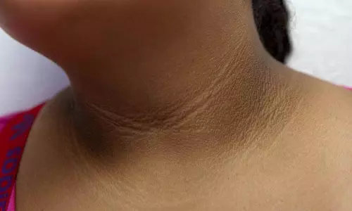 കഴുത്തിലെയും കക്ഷത്തിലെയും കറുത്തപാടുകള്‍ക്ക് കാരണം