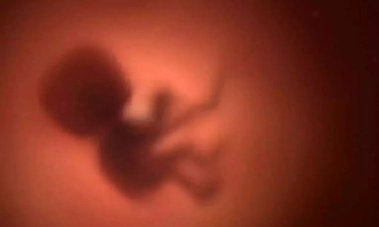 അത്യപൂർവങ്ങളിൽ അപൂർവം: റാഞ്ചിയിൽ നവജാതശിശുവിന്റെ വയറ്റിൽ എട്ട് ഭ്രൂണങ്ങൾ