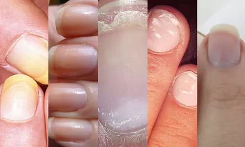 നഖം പറയും നിങ്ങളുടെ ആരോഗ്യത്തെ കുറിച്ച്