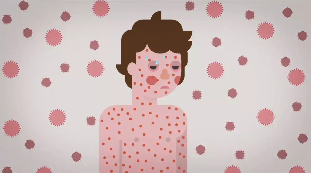 അഞ്ചാംപനിയെ കരുതലോടെ നേരിടാം