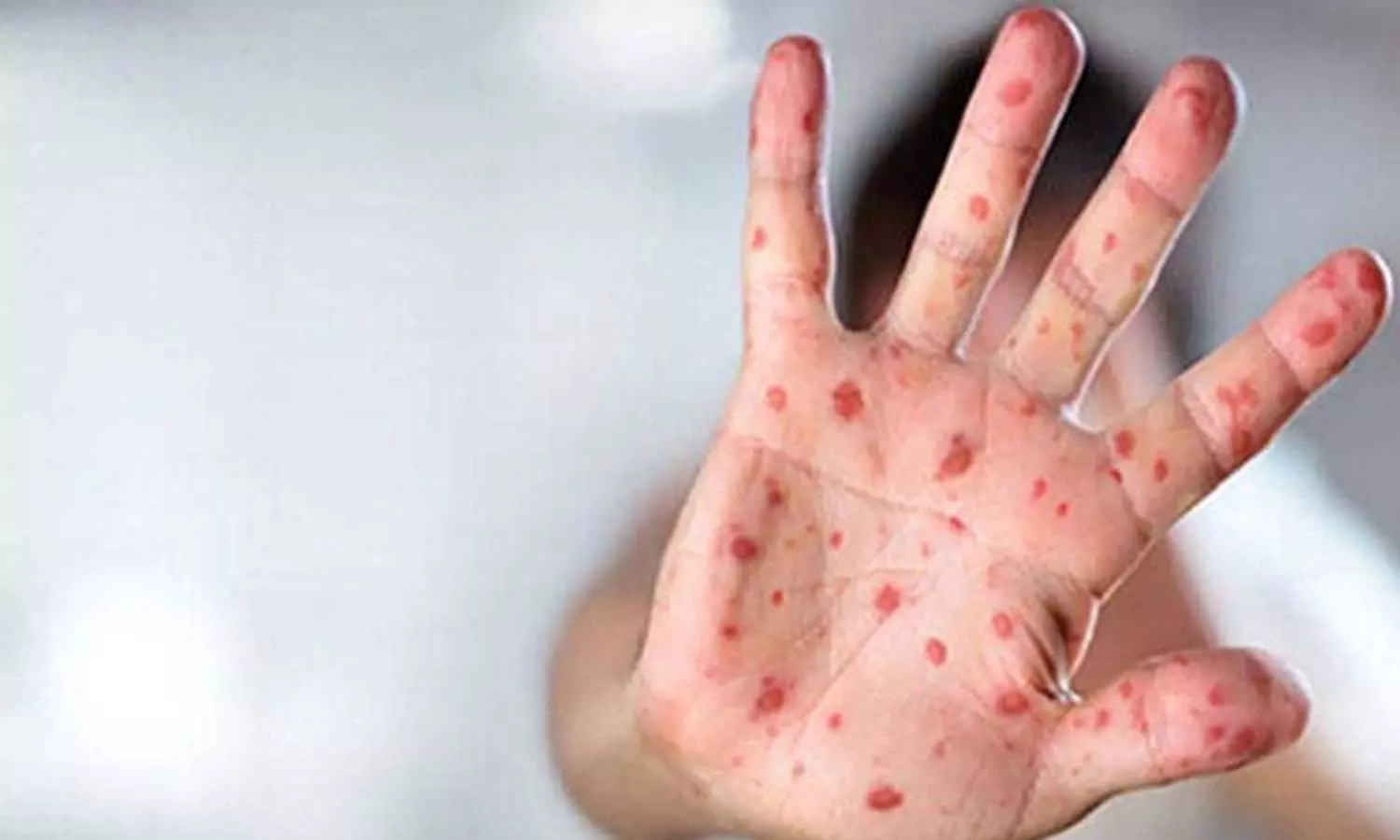 മലപ്പുറത്ത് അഞ്ചാംപനി വ്യാപിക്കുന്നു; പരിശോധനയ്ക്കായി കേന്ദ്രസംഘമെത്തി മലപ്പുറത്ത് അഞ്ചാംപനി വ്യാപിക്കുന്നു; പരിശോധനയ്ക്കായി കേന്ദ്രസംഘമെത്തി