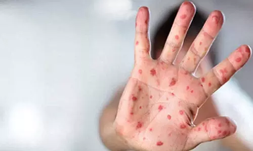 മലപ്പുറത്ത് അഞ്ചാംപനി വ്യാപിക്കുന്നു; പരിശോധനയ്ക്കായി കേന്ദ്രസംഘമെത്തി