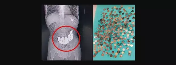 വിശപ്പ് മാറ്റാന് കഴിച്ചത് നാണയങ്ങള്; 58കാരന്റെ വയറ്റില് നിന്നും പുറത്തെടുത്തത് 187 നാണയത്തുട്ടുകള് വിശപ്പ് മാറ്റാന് കഴിച്ചത് നാണയങ്ങള്; 58കാരന്റെ വയറ്റില് നിന്നും പുറത്തെടുത്തത് 187 നാണയത്തുട്ടുകള്