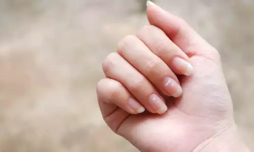ഉറക്കക്കുറവ് മുതൽ മാനസിക സമ്മർദ്ദം വരെ; നഖത്തിലെ വെളുത്ത വരകൾ നൽകുന്ന സൂചനകൾ