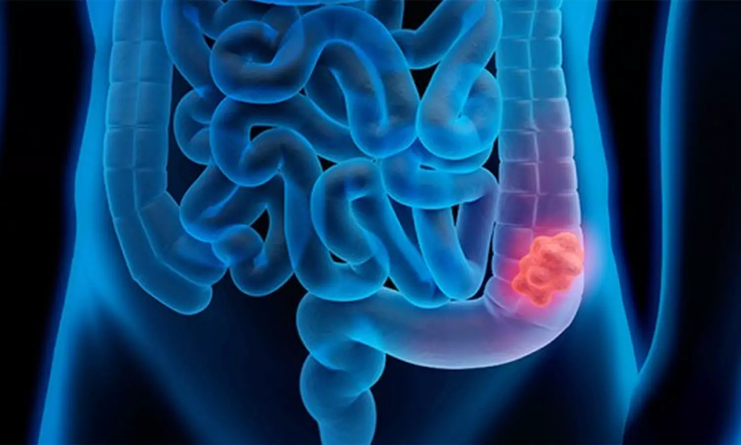 വൻകുടലിലെ അർബുദം:  പ്രധാന  ലക്ഷണങ്ങള്‍
