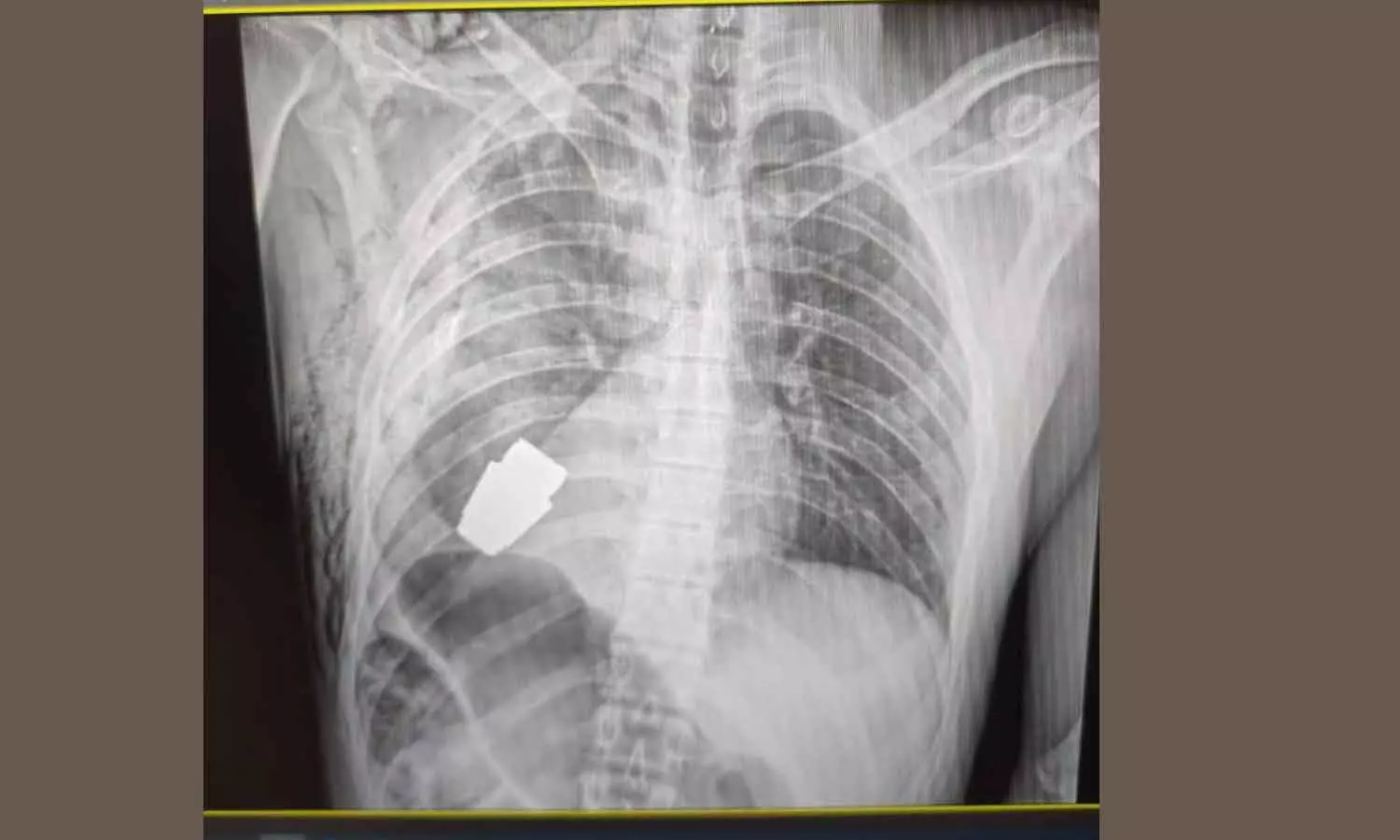 യുക്രൈൻ സൈനികന്റെ നെഞ്ചിൽ ഗ്രനേഡ്‌