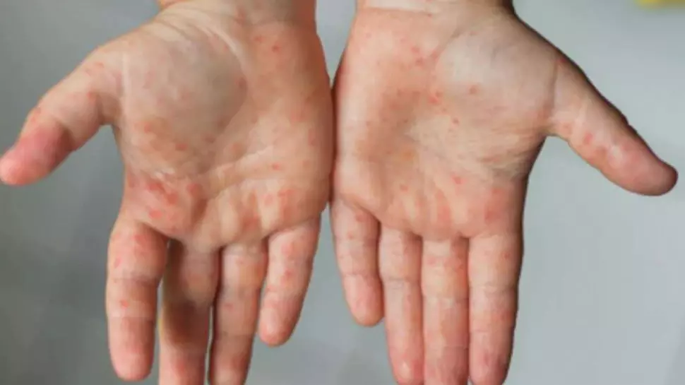 കോഴിക്കോട് നാദാപുരത്തും പരിസര പ്രദേശങ്ങളിലും അഞ്ചാം പനി പടര്‍ന്നു പിടിക്കുന്നു