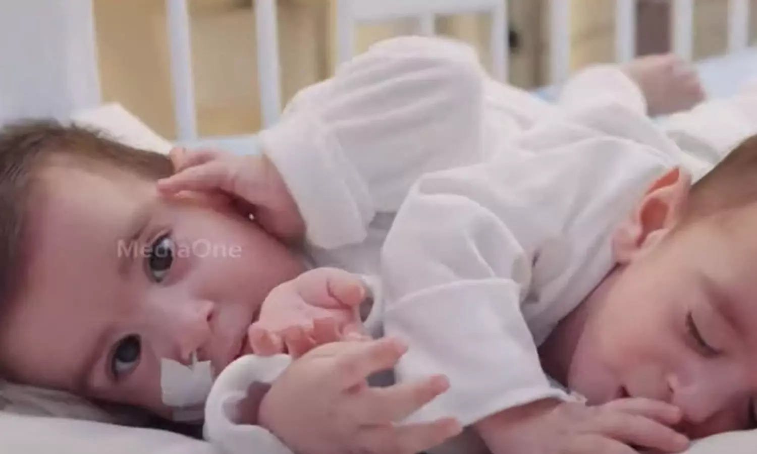 അലിയും ഉമറും ഇനി രണ്ട് ശരീരമായി ജീവിക്കും; സയാമീസ് ഇരട്ടകളെ സൗദിയിൽ വേർപ്പെടുത്തി