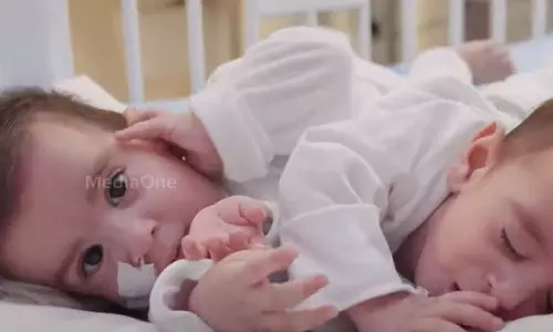 അലിയും ഉമറും ഇനി രണ്ട് ശരീരമായി ജീവിക്കും; സയാമീസ് ഇരട്ടകളെ സൗദിയിൽ വേർപ്പെടുത്തി