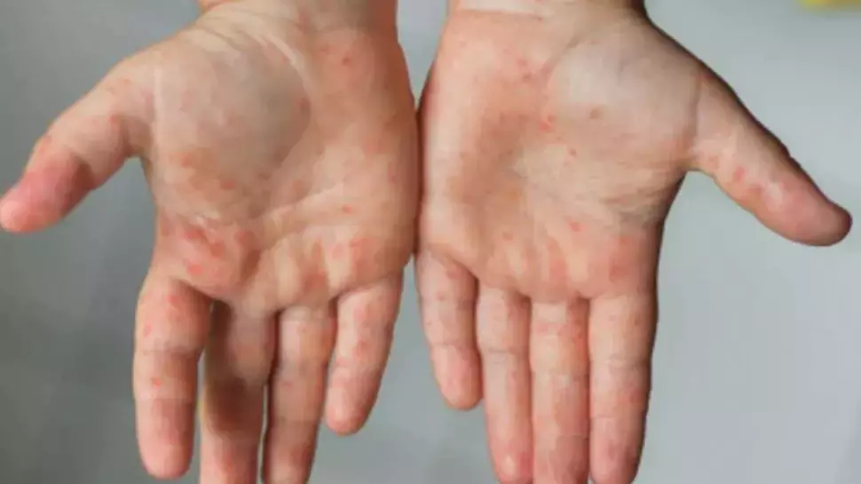 കോഴിക്കോട് നാദാപുരത്ത് അഞ്ചാംപനി പടർന്നു പിടിക്കുന്നു