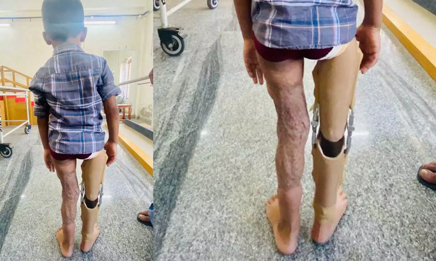 പാഞ്ഞ് വന്ന ലോറി സ്വപ്നങ്ങൾ മുറിച്ചുമാറ്റിയിട്ടില്ല; ആ അഞ്ച് വയസുകാരൻ ഇനിയും നടക്കും പാഞ്ഞ് വന്ന ലോറി സ്വപ്നങ്ങൾ മുറിച്ചുമാറ്റിയിട്ടില്ല; ആ അഞ്ച് വയസുകാരൻ ഇനിയും നടക്കും