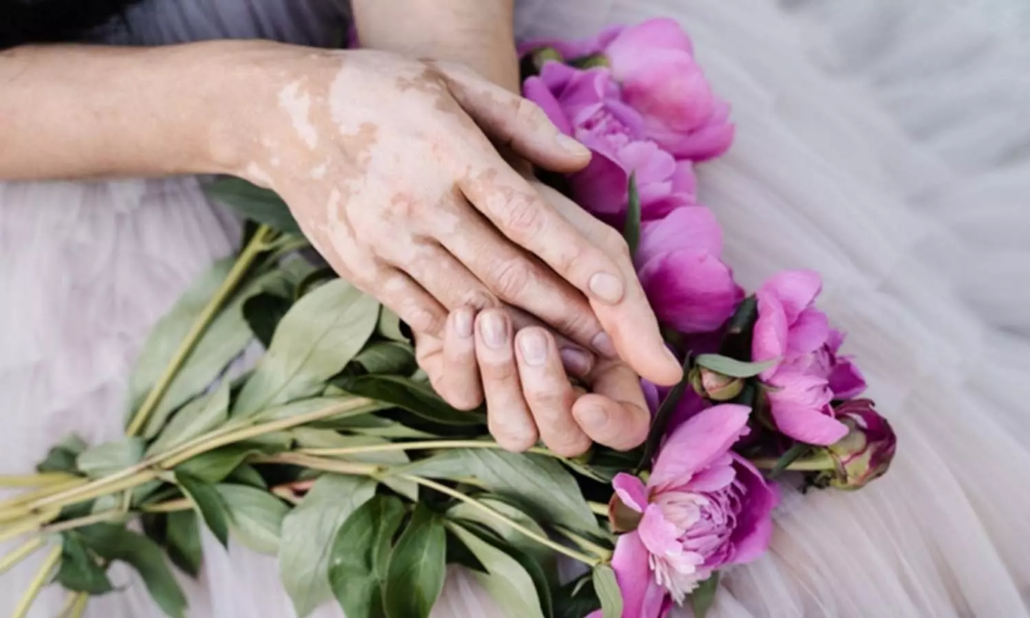 തൊട്ടാൽ പകരുന്ന രോഗമല്ല, പാരമ്പര്യമാണോ വെള്ളപ്പാണ്ട്; ഇനി സംശയം വേണ്ട തൊട്ടാൽ പകരുന്ന രോഗമല്ല, പാരമ്പര്യമാണോ വെള്ളപ്പാണ്ട്; ഇനി സംശയം വേണ്ട