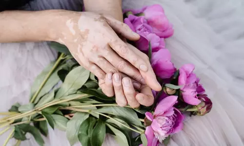 തൊട്ടാൽ പകരുന്ന രോഗമല്ല, പാരമ്പര്യമാണോ വെള്ളപ്പാണ്ട്; ഇനി സംശയം വേണ്ട