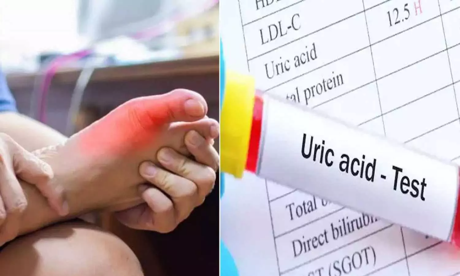 യൂറിക് ആസിഡ്,യൂറിക് ആസിഡുള്ളവര്‍ ഒഴിവാക്കേണ്ടത്, യൂറിക് ആസിഡുള്ളവര്‍ ഇതുകഴിക്കരുത് Uric Acid, Uric Acid Levels Are High,helth news