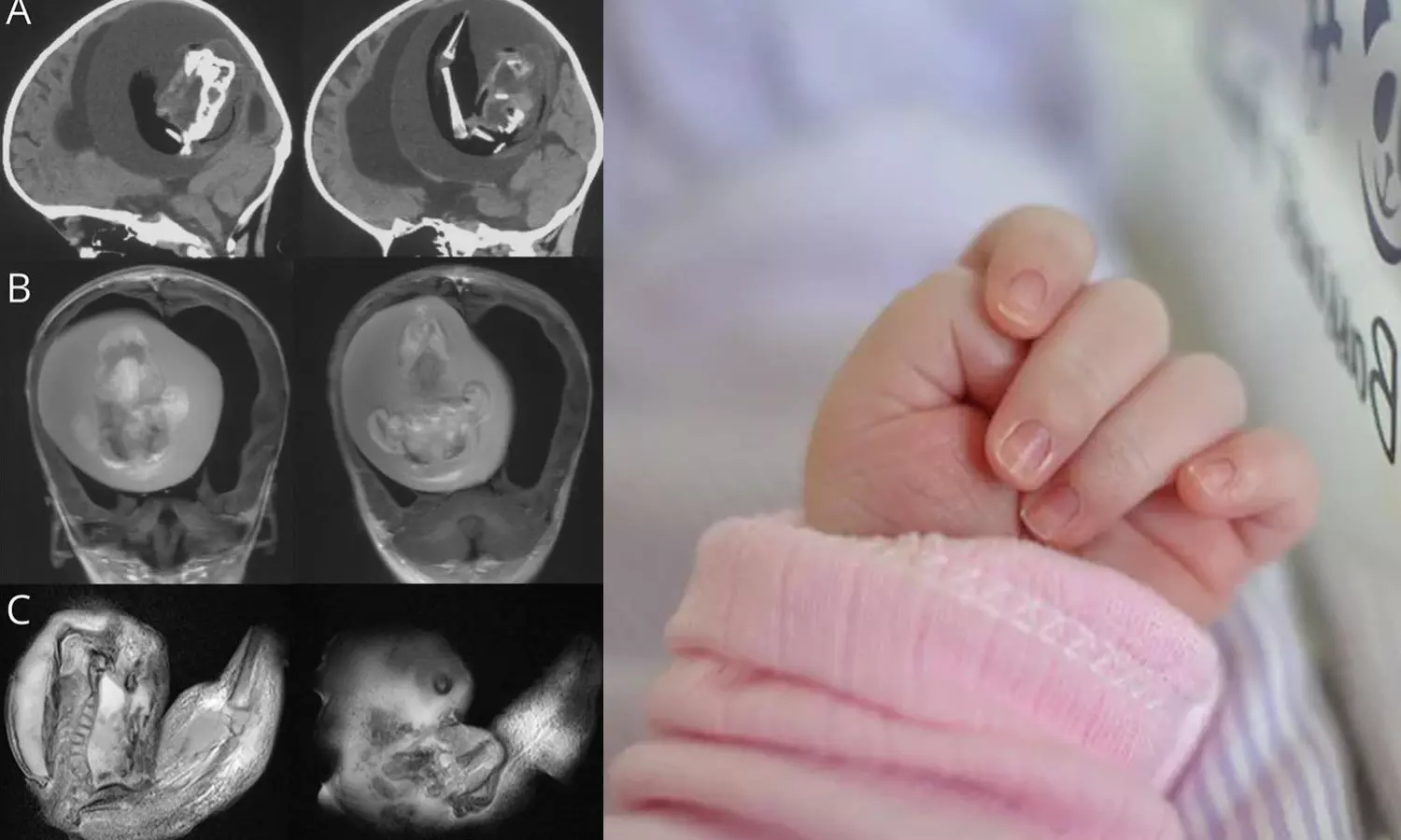 ഒരു വയസുള്ള കുഞ്ഞിന്റെ തലച്ചോറിനുള്ളിൽ ഇരട്ടയുടെ ഭ്രൂണം; സാഹസികമായി നീക്കം ചെയ്ത് ഡോക്ടർമാർ