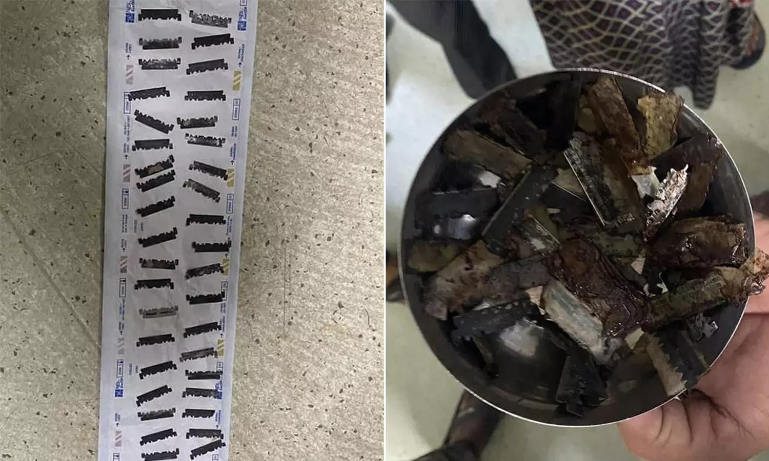 56 Pieces Of Razor Blades Found In Mans Stomach During Surgery