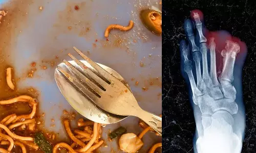 Studentlosesfingerseatingroommatesleftovernoodles, serioushealthissuesaftereatingleftovernoodles Studentlosesfingerseatingroommatesleftovernoodles, serioushealthissuesaftereatingleftovernoodles