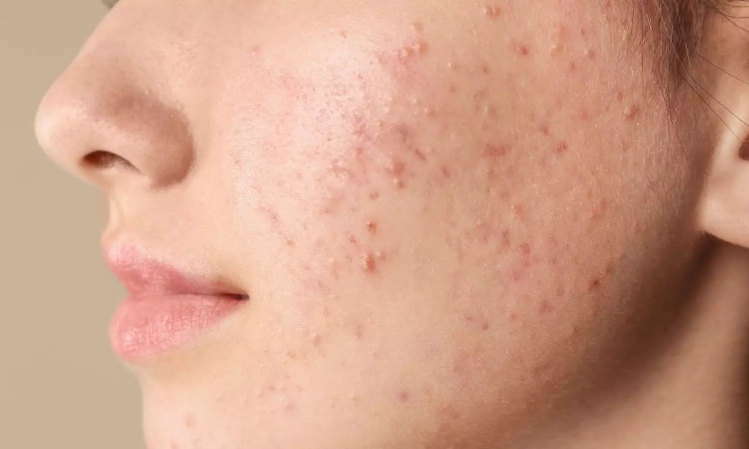 pimples, latest malayalam news, face, hormon variations