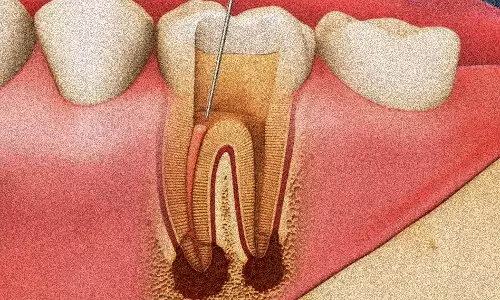 റൂട്ട് കനാല്‍ ചികിത്സ