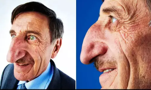 Man With Worlds Longest Nose, Dies At 75