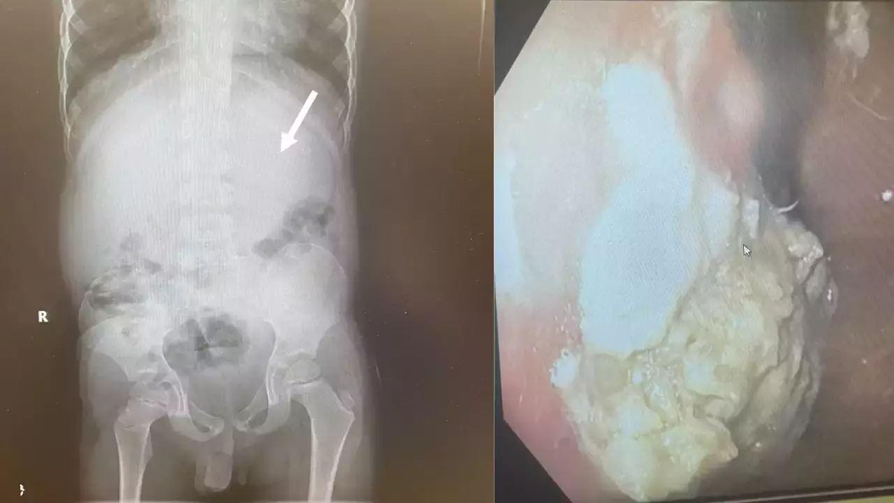 5-year-old swallows 40 pieces of gum