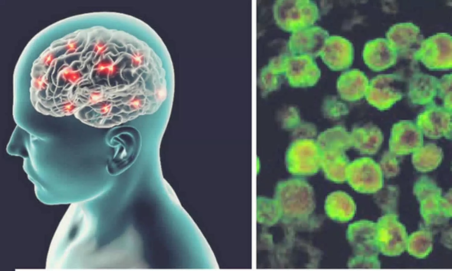 Primary amebic meningoencephalitis