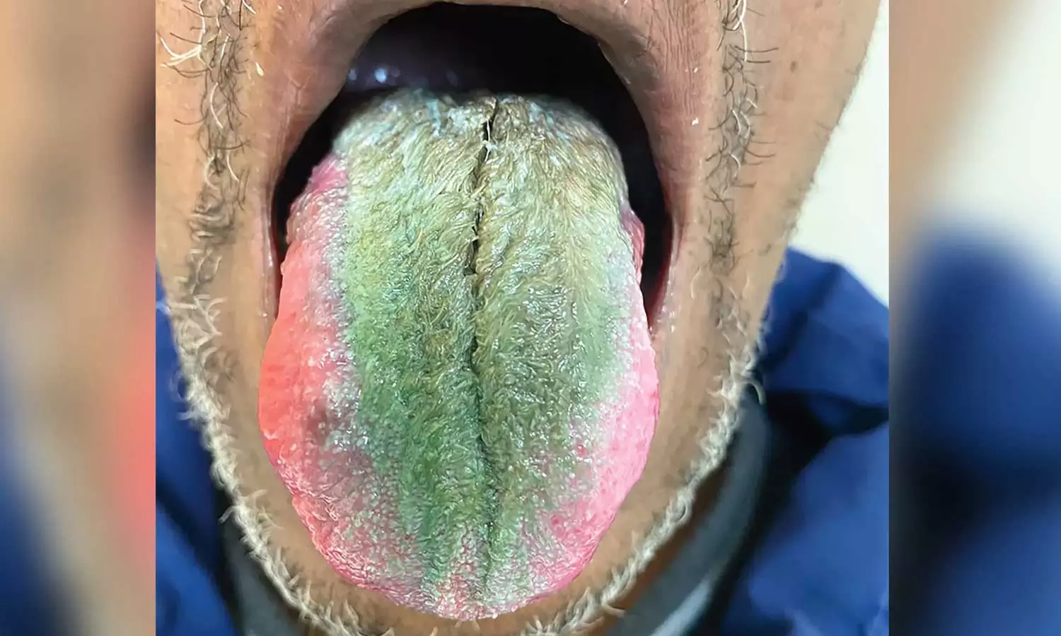 Tobacco Users Tongue Sprouts Green Hair