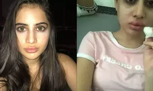 Urfi Javed shares results of lip fillers that went wrong when she was younger