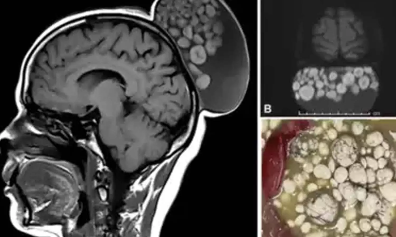 mature cystic teratomas