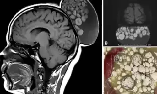 mature cystic teratomas