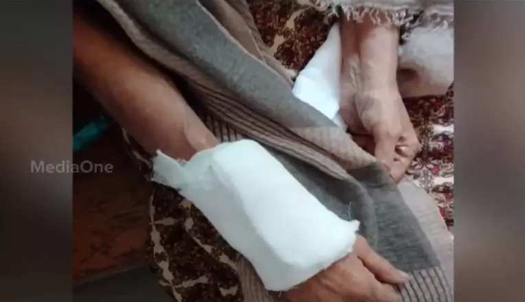 കോഴിക്കോട് എട്ടുപേരെ ആക്രമിച്ച തെരുവുനായക്ക് പേവിഷബാധ