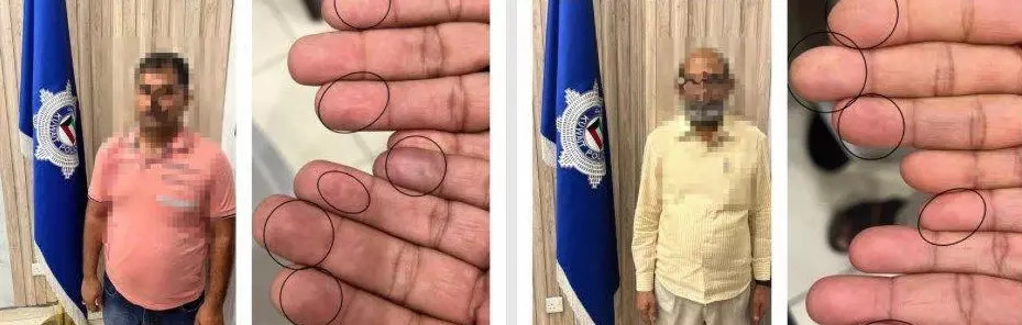 Fake fingerprints through surgery