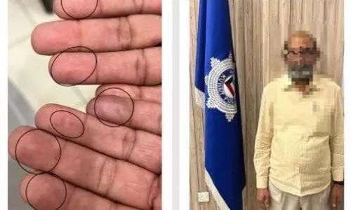 Fake fingerprints through surgery