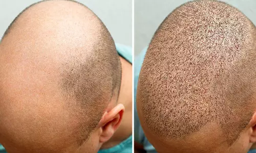 ​ഹെയർ ട്രാന്‍സ്പ്ലാന്റ് ചെയ്താൽ മാത്രം മതിയോ? മുടി വളരാൻ ശ്രിദ്ധിക്കേണ്ട കാര്യങ്ങള്‍