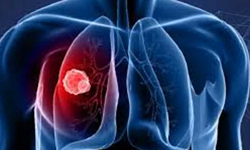 കുവൈത്തില്‍ അർബുദ ബാധിതർ വര്‍ദ്ധിക്കുന്നു: ബോധവൽക്കരണ കാമ്പയിൻ ആരംഭിച്ചു