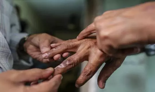 കുഷ്ഠരോഗം; ശരീരത്തിൽ നിറവ്യത്യാസമുണ്ടെങ്കിൽ ചികിത്സ തേടണം, ആശങ്ക വേണ്ടെന്ന് ആരോഗ്യവകുപ്പ് കുഷ്ഠരോഗം; ശരീരത്തിൽ നിറവ്യത്യാസമുണ്ടെങ്കിൽ ചികിത്സ തേടണം, ആശങ്ക വേണ്ടെന്ന് ആരോഗ്യവകുപ്പ്