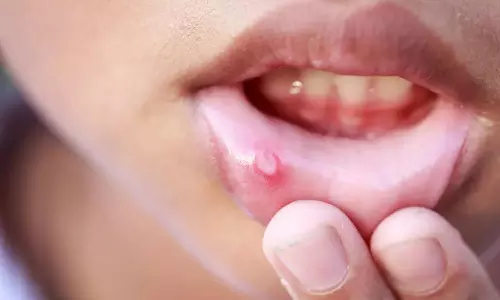 mouth ulcers, health tips, latest malayalam news, വായിൽ അൾസർ, ആരോഗ്യ നുറുങ്ങുകൾ, ഏറ്റവും പുതിയ മലയാളം വാർത്തകൾ mouth ulcers, health tips, latest malayalam news, വായിൽ അൾസർ, ആരോഗ്യ നുറുങ്ങുകൾ, ഏറ്റവും പുതിയ മലയാളം വാർത്തകൾ