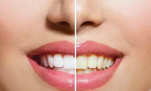 പല്ലിലെ മഞ്ഞനിറമാണോ പ്രശ്നം? ഭക്ഷണശീലത്തിൽ ഇവ ഉൾപ്പെടുത്തൂ...